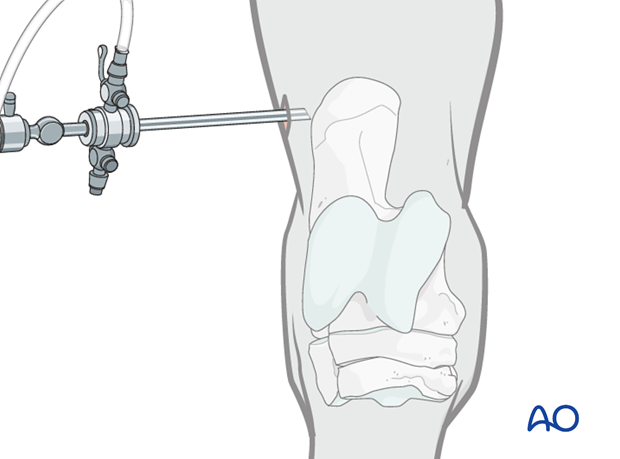 Fractures of the tuber calcanae