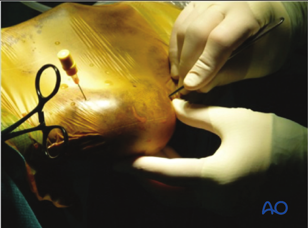 Fractures of the tuber calcanae