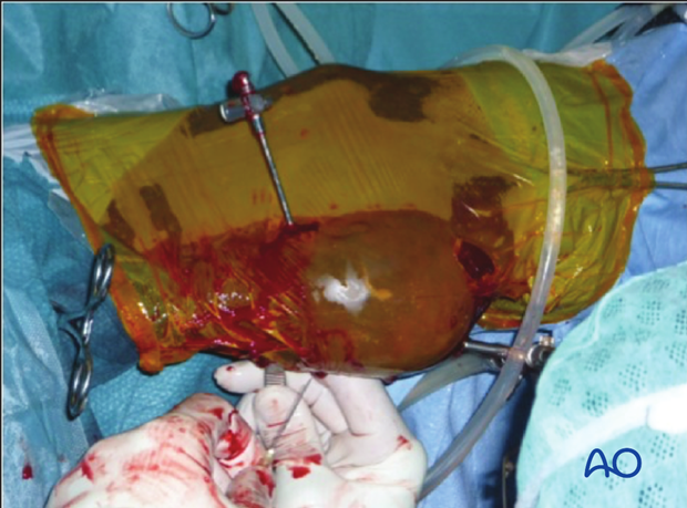 Fractures of the tuber calcanae