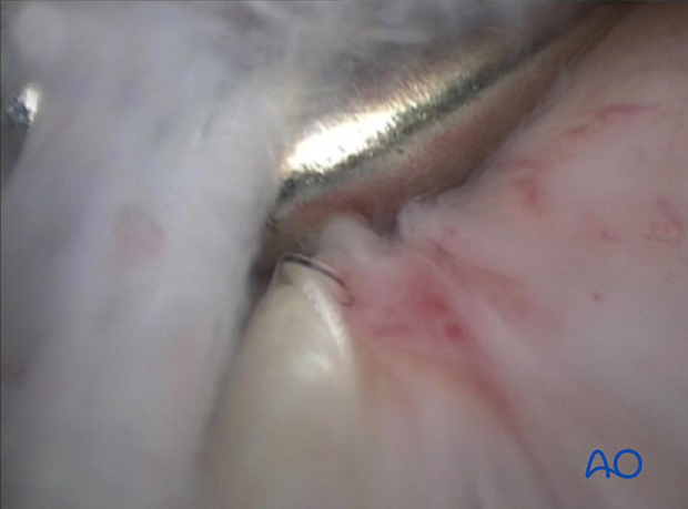 Fractures of the tuber calcanae