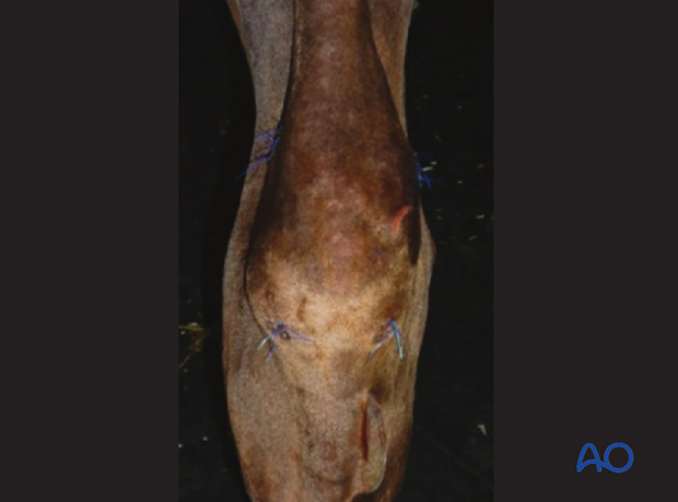 Fractures of the tuber calcanae