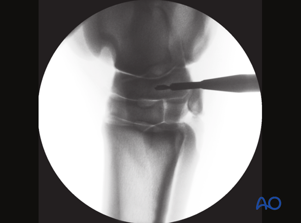 Simple fractures of the central tarsal bone - screw fixation