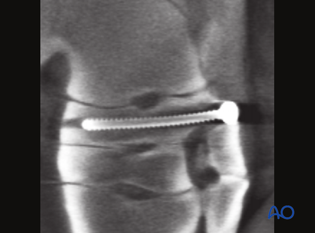Simple fractures of the central tarsal bone - screw fixation