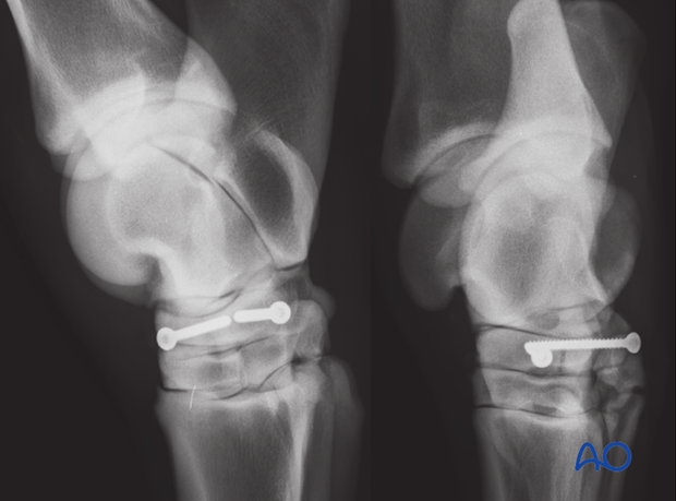 Comminuted fractures of the central tarsal bone - screw fixation
