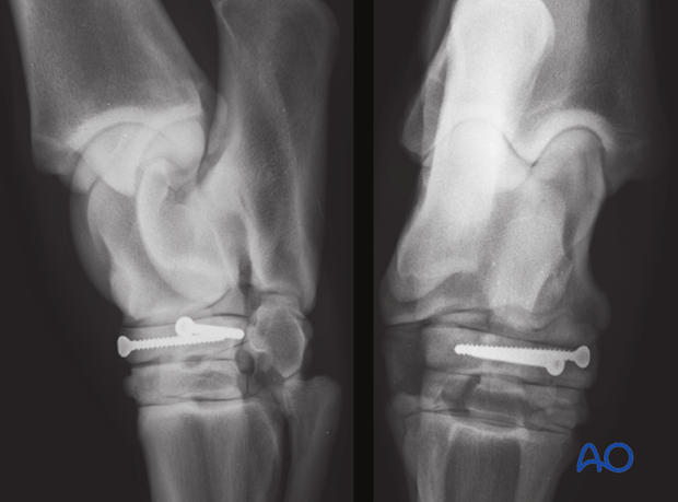 Comminuted fractures of the central tarsal bone - screw fixation