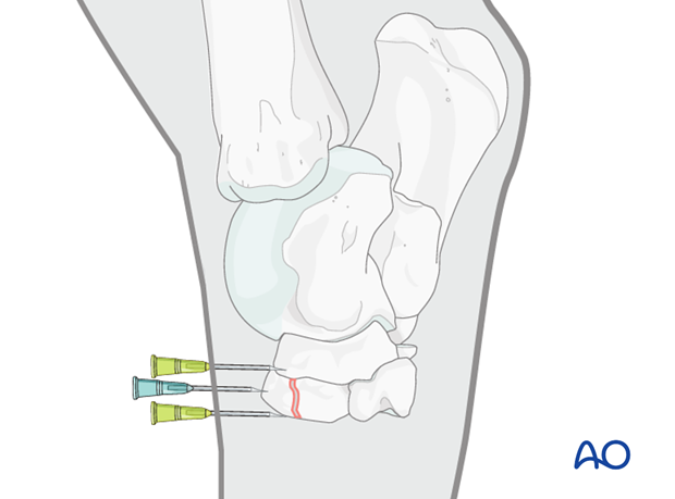 Fractures of the third tarsal bone - screw fixation