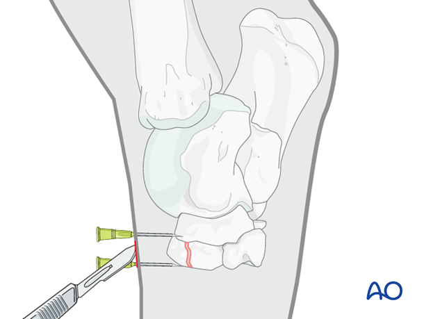 Fractures of the third tarsal bone - screw fixation