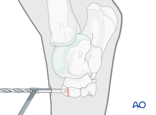 Fractures of the third tarsal bone - screw fixation