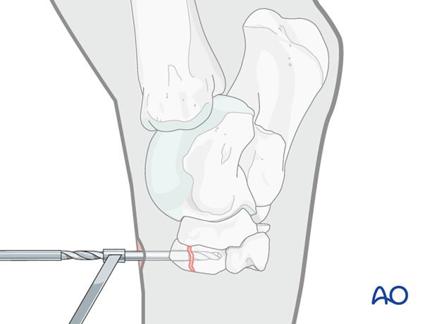 Fractures of the third tarsal bone - screw fixation