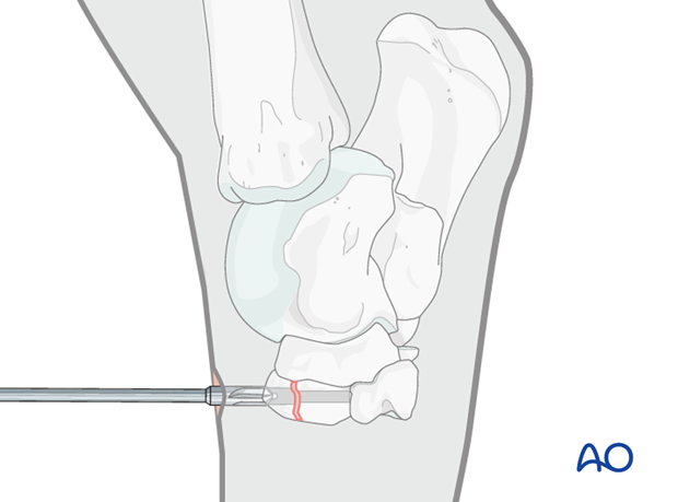 Fractures of the third tarsal bone - screw fixation