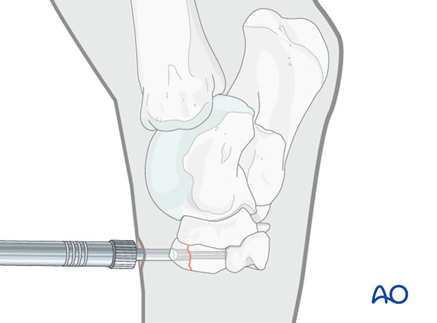 Fractures of the third tarsal bone - screw fixation