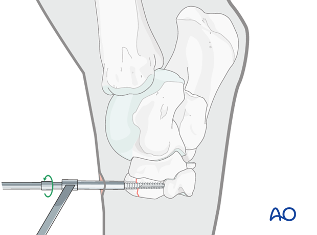 Fractures of the third tarsal bone - screw fixation