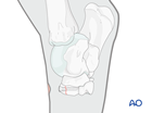 Fractures of the third tarsal bone - screw fixation
