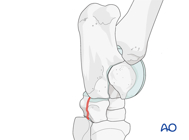 Fractures of the 1st, 2nd and 4th tarsal bones
