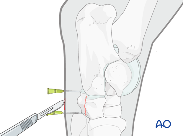 H80_C230_i130 Fractures of the first, second and fourth tarsal bones - screw fixation