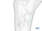 Fractures of the first, second and fourth tarsal bones - screw fixation
