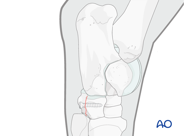 H80_C230_i140 Fractures of the first, second and fourth tarsal bones - screw fixation