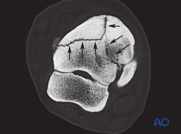 H80_D00_x100 Fractures of the tarsal bones