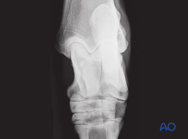 Sagittal fractures of the talus