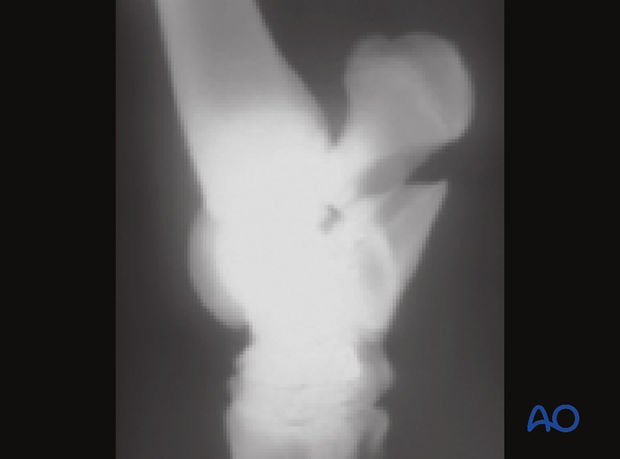 H80_D02_x100 Fractures of the calcaneus