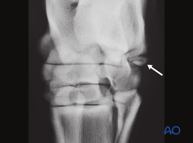 H80_D02_x300 Fractures of the attachment of the collateral ligaments of the calcaneus