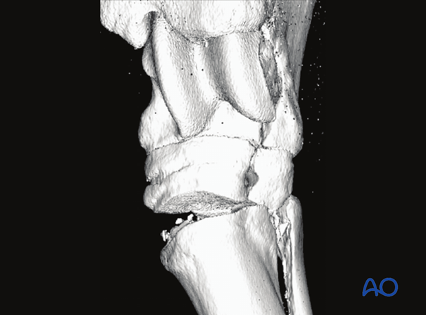 Fractures of the 1st, 2nd and 4th tarsal bones