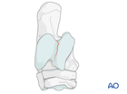 Complete sagittal fractures of the talus - nonsurgical treatmetn