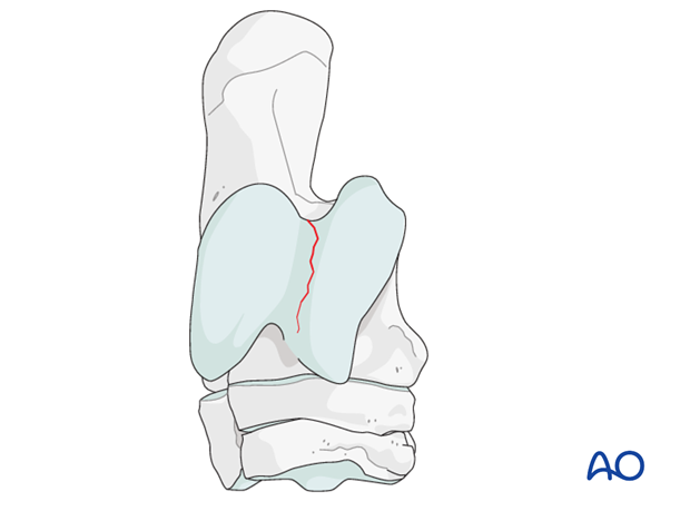 Sagittal fractures of the talus