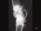 Fractures of the third tarsal bone - nonsurgical treatment