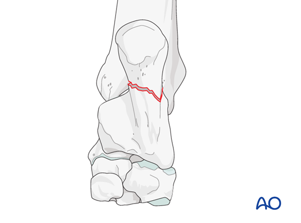 H80_O170_i100 Fractures of the calcaneal shaft