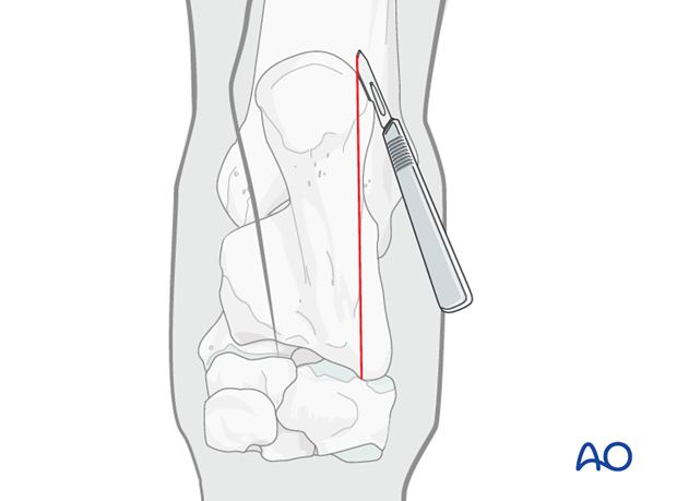 plate fixation