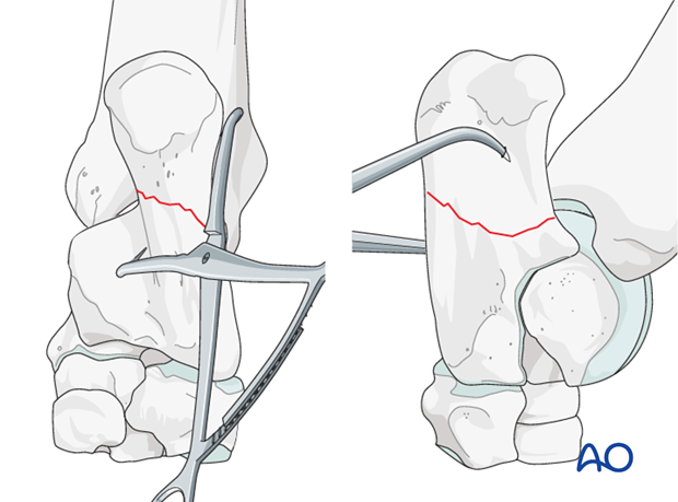 Calcaneus - simple fracture of the shaft - plate fixation