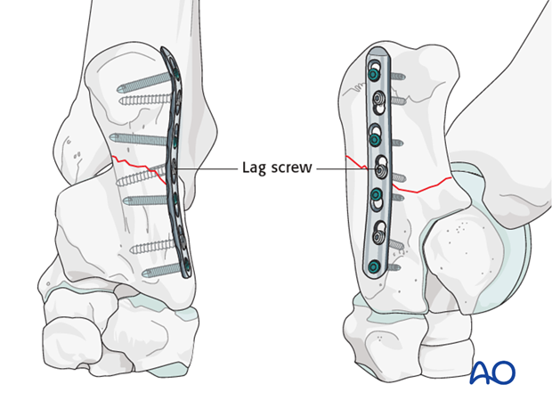 Calcaneus - simple fracture of the shaft - plate fixation