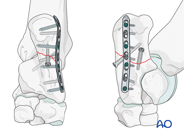 Calcaneus - simple fracture of the shaft - plate fixation