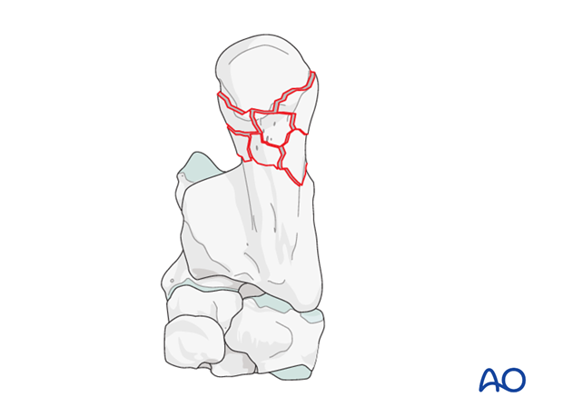 H80_O180_i200 Fractures of the calcaneal shaft