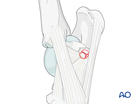 Calcaneus - fractures of the sustentaculum tali