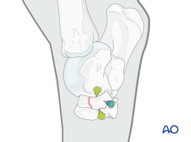 Simple fractures of the central tarsal bone - screw fixation