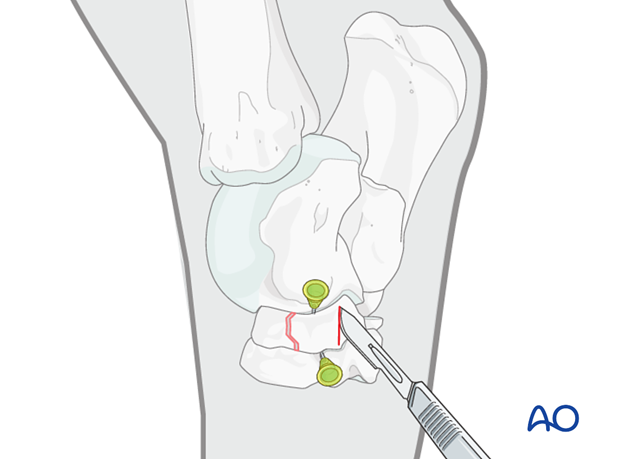 Simple fractures of the central tarsal bone - screw fixation