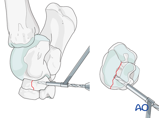 Simple fractures of the central tarsal bone - screw fixation