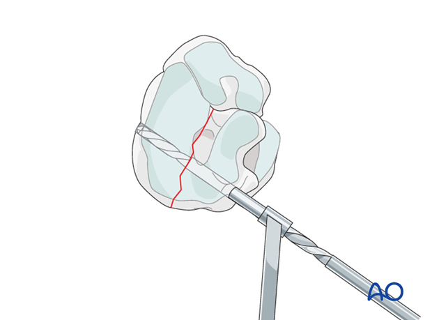 Simple fractures of the central tarsal bone - screw fixation