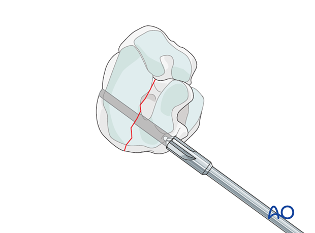 Simple fractures of the central tarsal bone - screw fixation