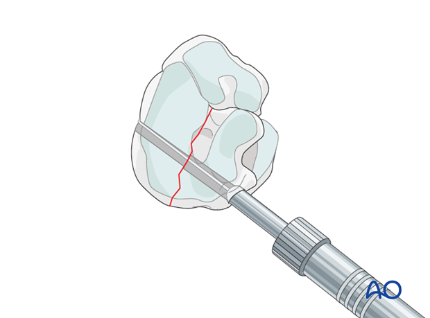 Simple fractures of the central tarsal bone - screw fixation