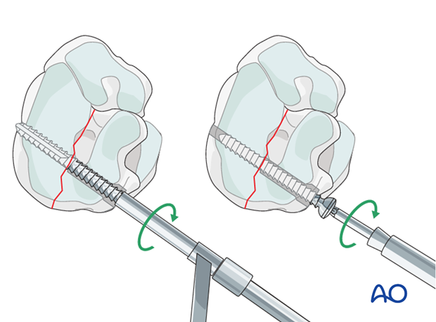 Simple fractures of the central tarsal bone - screw fixation