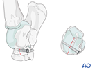 Simple fractures of the central tarsal bone - screw fixation