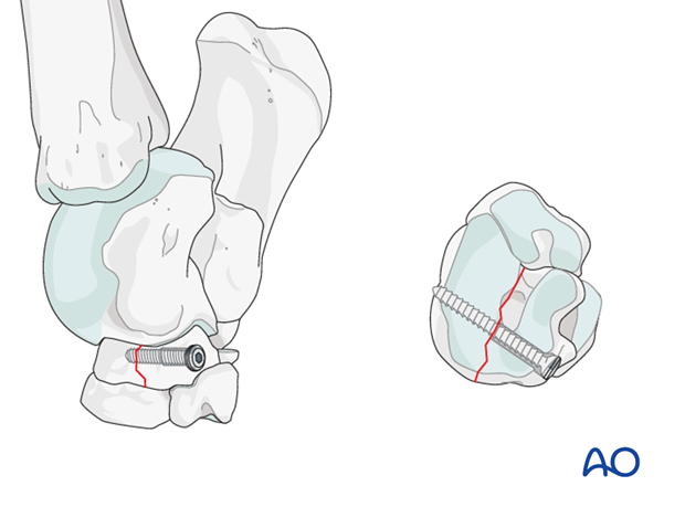 Simple fractures of the central tarsal bone - screw fixation