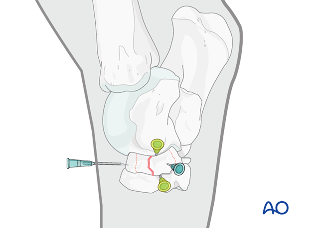 Comminuted fractures of the central tarsal bone - screw fixation