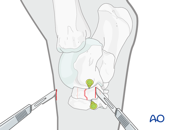 Comminuted fractures of the central tarsal bone - screw fixation