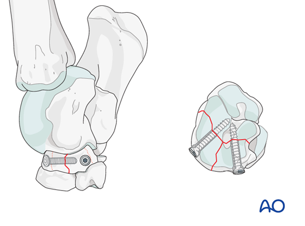 Comminuted fractures of the central tarsal bone - screw fixationComminuted fractures of the central tarsal bone - screw fixation
