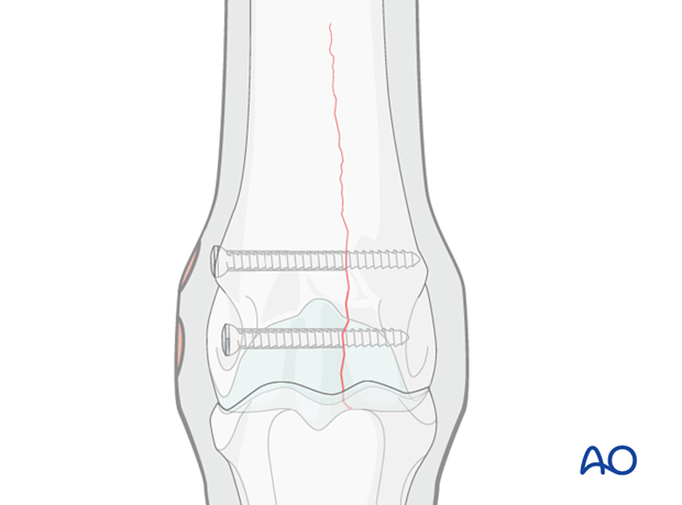 Medial incomplete condylar fracture - plate fixation