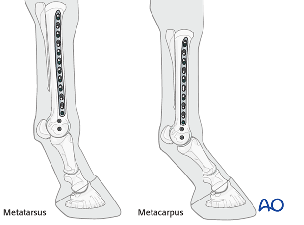 Medial incomplete condylar fracture - plate fixation